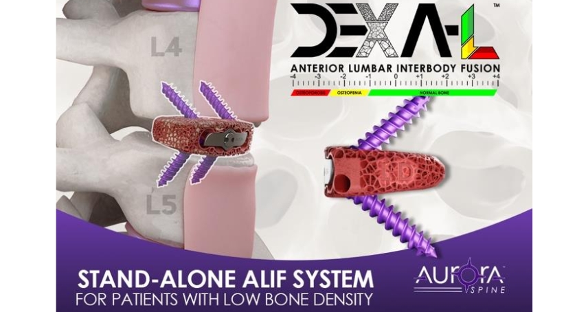 Aurora Spine Releases DEXA-L ALIF Device
